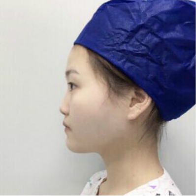 成都美立方（原華博）醫(yī)療美容醫(yī)院做肋軟骨隆鼻手術(shù)前的鼻子