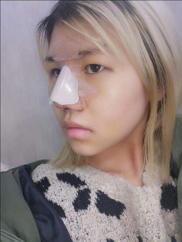 成都蜀尚蓉雅美容整形醫(yī)院做鼻綜合手術(shù)后的第六天鼻子