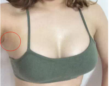 南京美貝爾醫(yī)療美容醫(yī)院做假體隆胸手術(shù)后的一個(gè)月 南京美貝爾醫(yī)療美容醫(yī)院做假體隆胸手術(shù)后的一個(gè)月