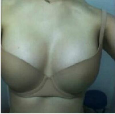 長沙愛思特醫(yī)療美容醫(yī)院吳蒙做假體隆胸案例效果分享