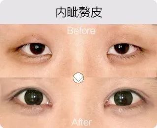 哈爾濱成美整形內(nèi)眥贅皮矯正怎么樣有哪幾種手術(shù)方法？