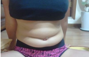 東莞華美醫(yī)療美容醫(yī)院做腰腹吸脂術(shù)前