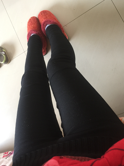 蘇州圣愛醫(yī)院醫(yī)療美容科做大腿吸脂手術(shù)后的日常 蘇州圣愛醫(yī)院醫(yī)療美容科做大腿吸脂手術(shù)后的日常