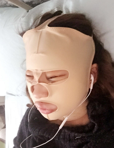 北京京民醫(yī)院(原釣魚臺醫(yī)院)整形外科做下頜骨手術(shù)后的恢復情況 北京京民醫(yī)院(原釣魚臺醫(yī)院)整形外科做下頜骨手術(shù)后的恢復情況